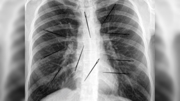 Mujer vive 20 años con agujas en el cuerpo sin saberlo
