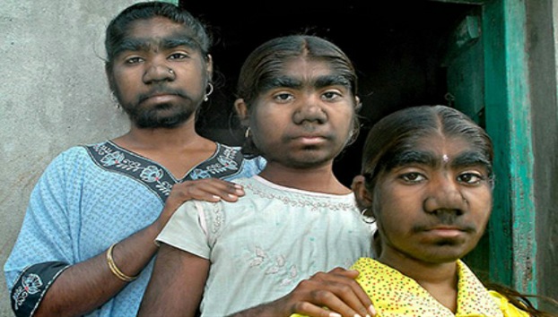Las tres hermanas 'lobo' de la India buscan el remedio a su mal en Rusia