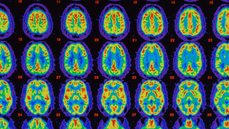 Desarrollan el primer medicamento que puede frenar el alzhéimer
