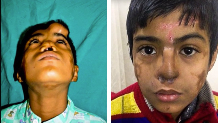 Implantan a un niño una nariz en la frente antes de obrar un milagro