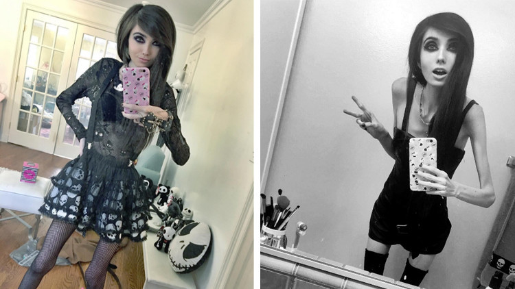 ¿Induce YouTube a la anorexia?: Una joven esquelética de 27 kilos causa polémica en Internet