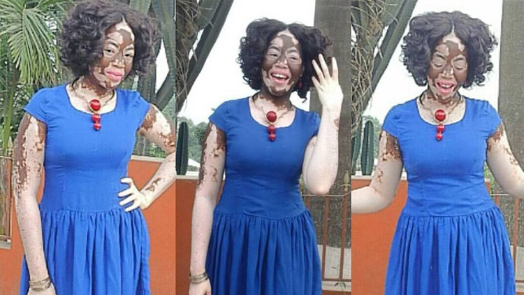 Cómo esta enfermera con vitíligo superó el 'bullying' y se convirtió en modelo