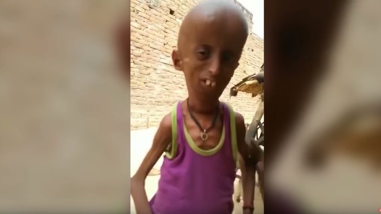 Este indio de 21 años vive atrapado en el cuerpo de un anciano (VIDEO, FOTOS)