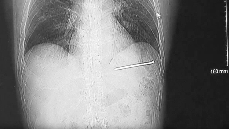 Se dispara una pistola de clavos en el corazón, se limpia y maneja hasta el hospital (FOTOS)