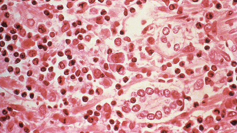 En este país latinoamericano un virus mortal ha aumentado su incidencia en un 81%