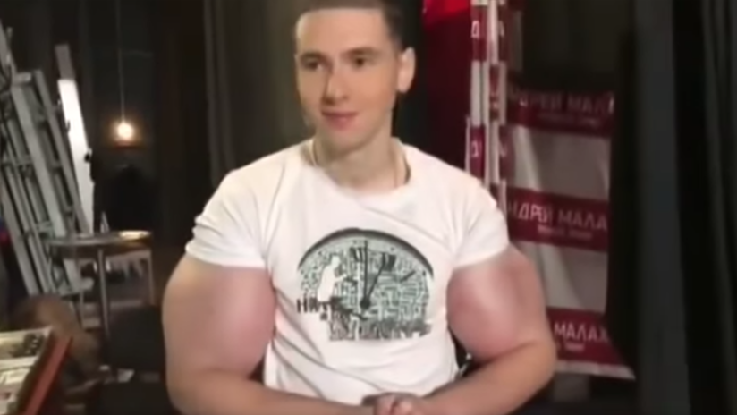 'Hulk' ruso en riesgo de amputación por inyectarse una mezcla casera en sus brazos (Video, fotos)