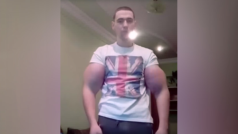 Le extraen los músculos de Synthol al 'hulk ruso' y se los cambian por implantes de silicona