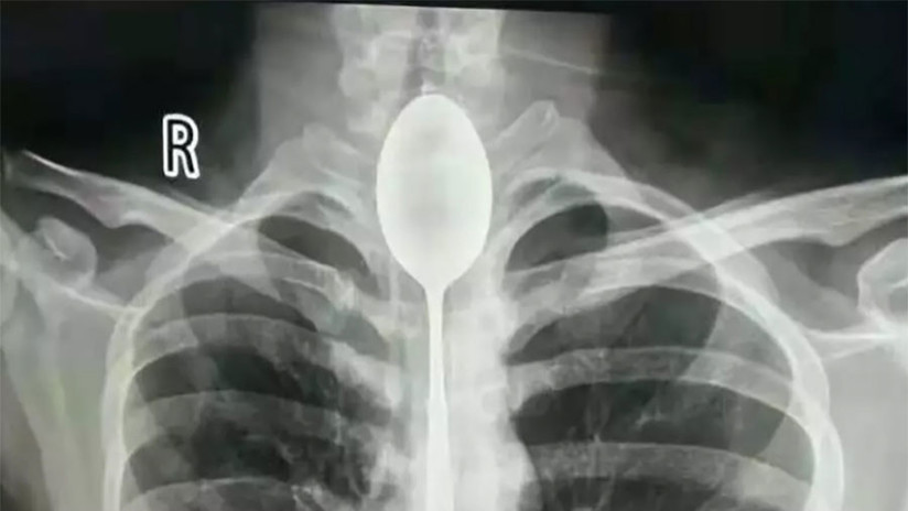 FOTOS: Se traga una cuchara de 20 centÃmetros y logran retirársela un año más tarde