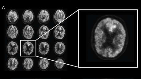 Una imagen de tomografía practicada a un paciente al que se está desarrollando el alzhéimer
