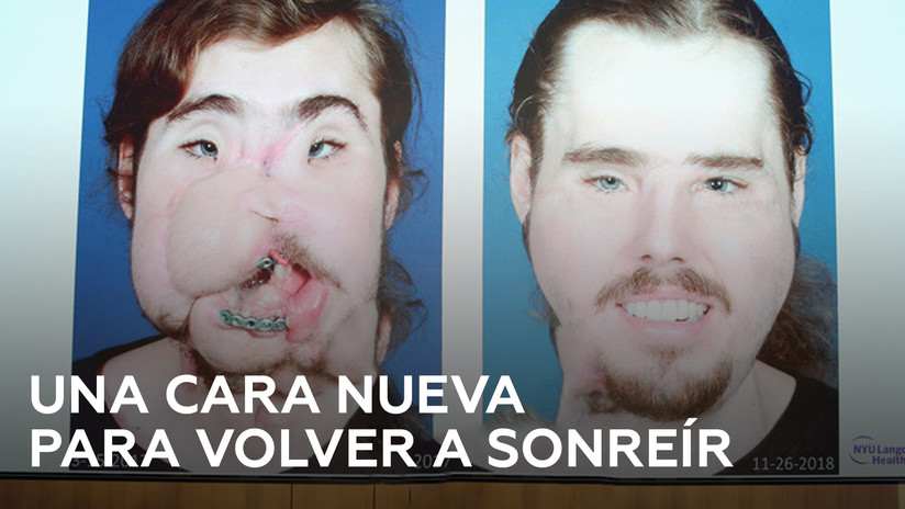Recibe un rostro nuevo tras su intento de suicidio