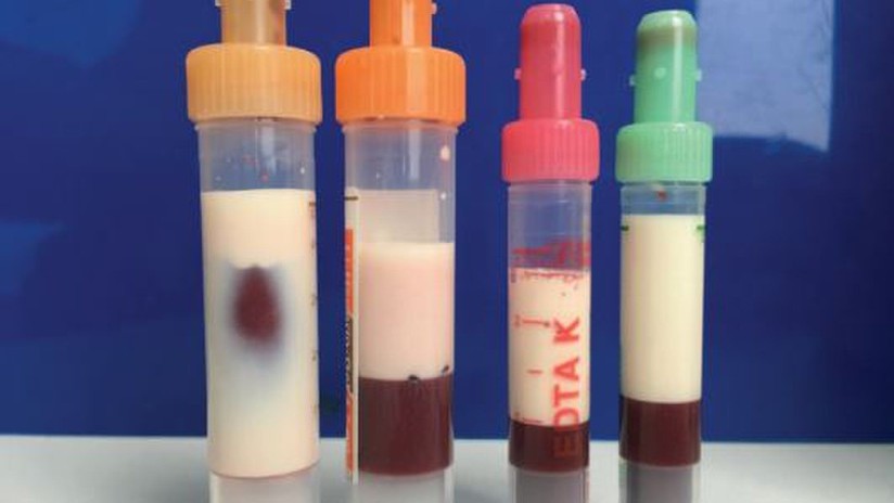 O sangue é extraÃdo de um paciente diabético completamente branco por gordura, que estava perto de matá-lo