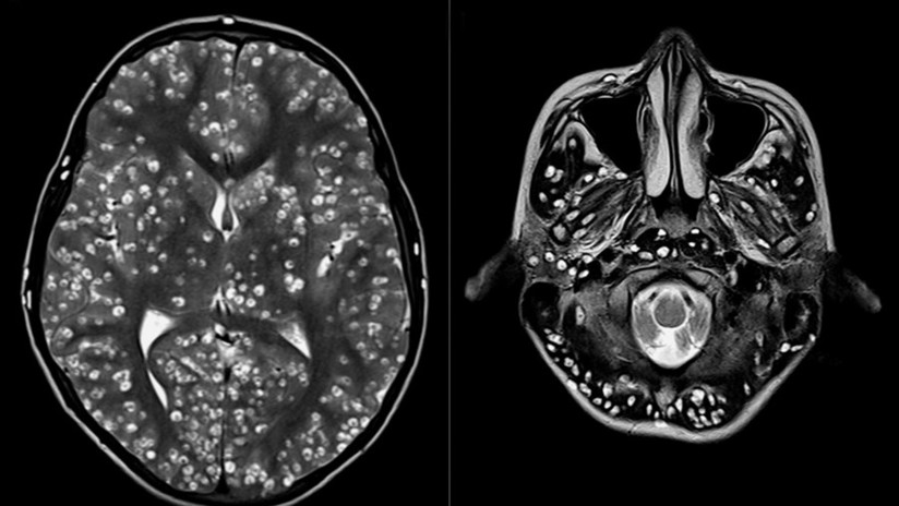 Acude al hospital con un fuerte dolor de cabeza y le hallan una plaga de larvas en el cerebro