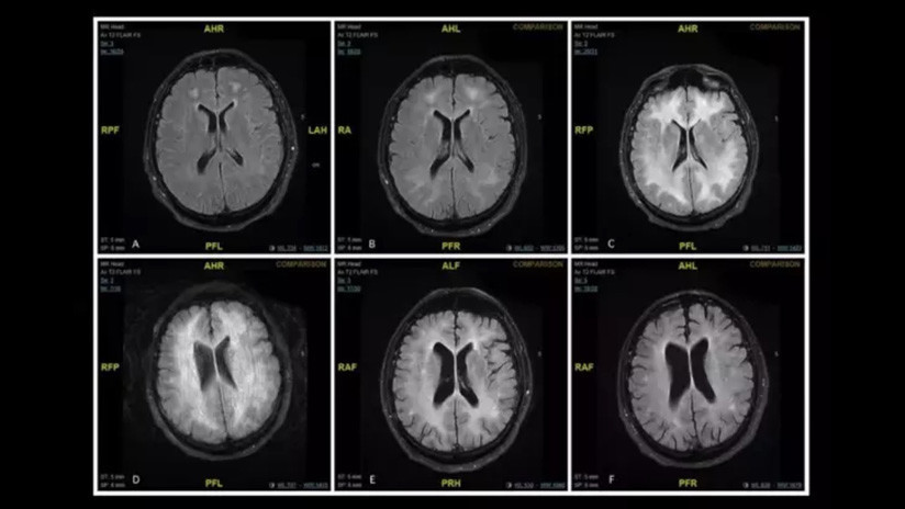 FOTO: Así se 'devora' el cerebro el consumo de cocaína