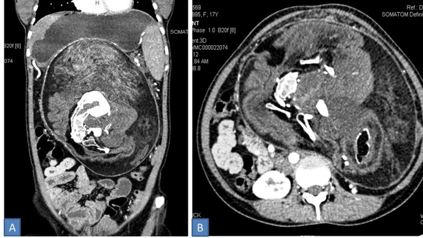 "Una condición extremadamente rara": Una joven vivió 17 años con un 'gemelo' dentro de su cuerpo sin saberlo