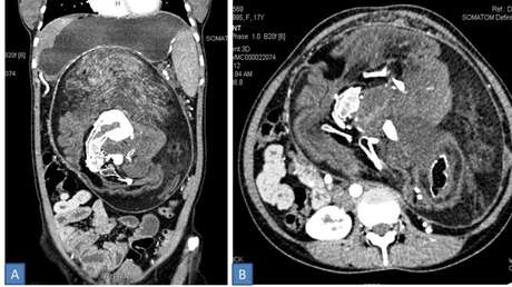 "Una condición extremadamente rara": Una joven vivió 17 años con un 'gemelo' dentro de su cuerpo sin saberlo