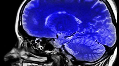 Científicos crean el primer 'aneurisma viviente' impreso en 3D fuera del cerebro humano