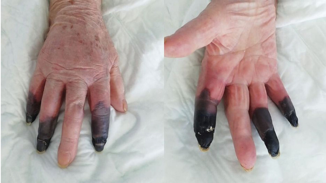 Amputan tres dedos a una mujer que desarrolló gangrena tras dar positivo por covid-19