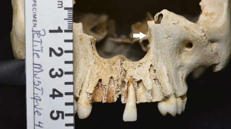 Encuentran evidencia de lepra en un cráneo de 200 años descubierto en una isla caribeña deshabitada
