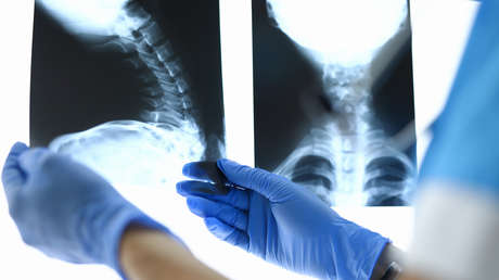 Los pacientes con lesiones de la médula espinal tienen casi un 80 % más de riesgo de desarrollar enfermedades psicológicas, según un estudio