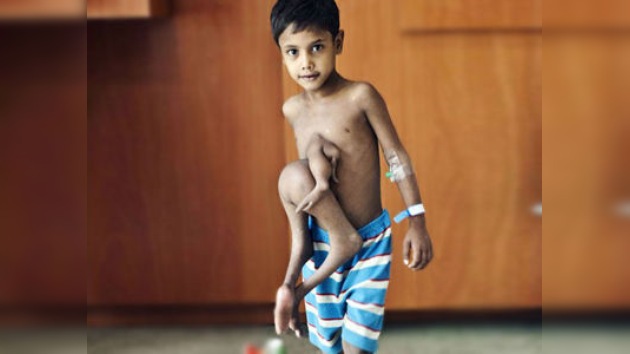 Un 'niño araña' vuelve a disfrutar de la vida