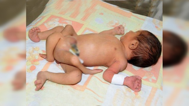Médicos: 'No es un bebé con seis piernas, sino gemelos unidos'