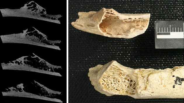 Diagnostican el primer tumor humano de 120.000 años