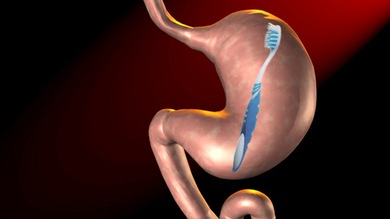 Un cepillo de dientes en un estómago, invisible para los rayos X