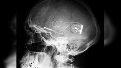 Nueva retina electrónica da esperanzas a los invidentes