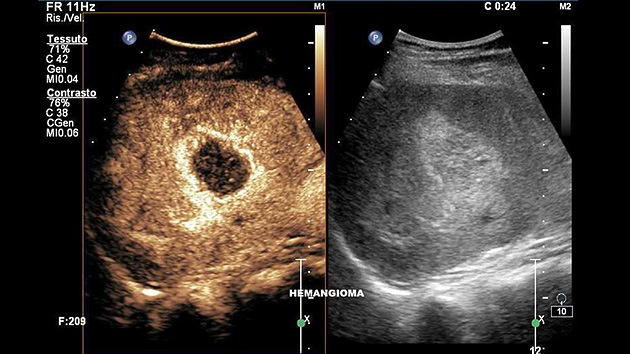 Crean un escáner capaz de detectar el cáncer de manera precisa en las fases precoces
