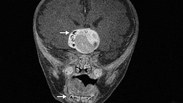 Hallan dientes en el cerebro de un bebé debido a un tumor poco frecuente