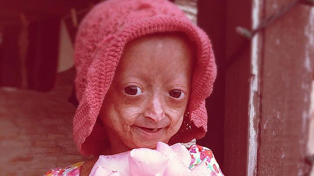 VIDEO: Una niña que sufre envejecimiento prematuro lanza una emotiva campaña