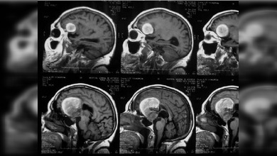 Desarrollan una nueva técnica para detectar aneurismas cerebrales