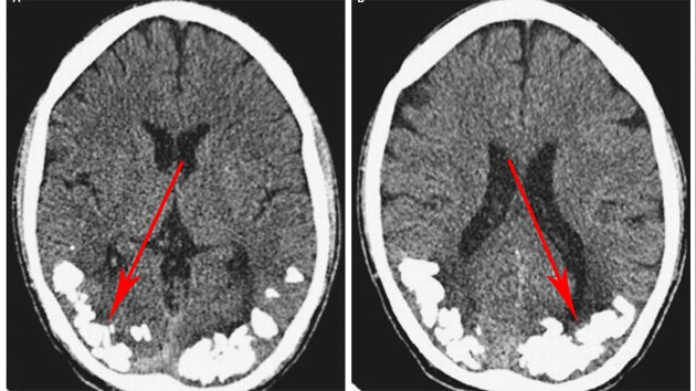 Hallan piedras en el cerebro de un brasileño que sufría dolores de cabeza