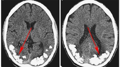 Hallan piedras en el cerebro de un brasileño que sufría dolores de cabeza