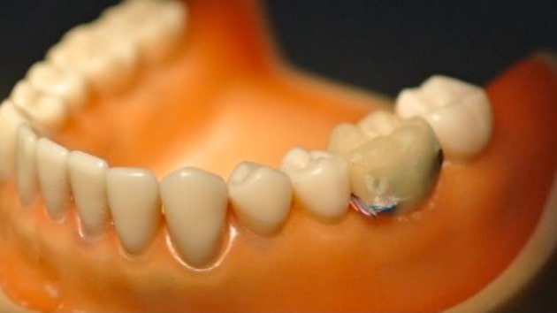 Crean un chip dental que recolecta información sobre la salud de la persona