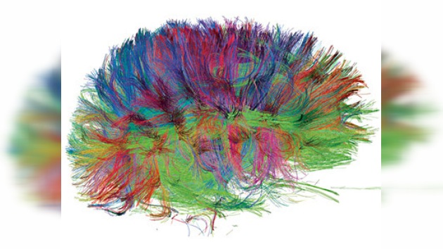 El Alzheimer ahora se puede detectar a través de un escáner cerebral