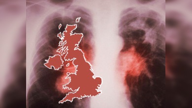 Londres, capital europea de la tuberculosis