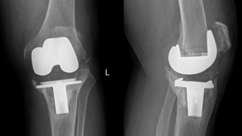 Erste Knie-OP mit 3D-gedrucktem Gelenk aus Tantal in China durchgeführt