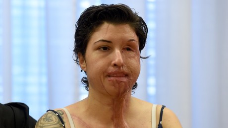 Säure-Opfer bekommt Briefe von Täter aus Gefängnis
