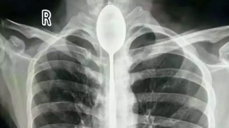 Mann trägt 20-Zentimeter-Löffel im Hals – und sucht erst ein Jahr später ärztliche Hilfe 