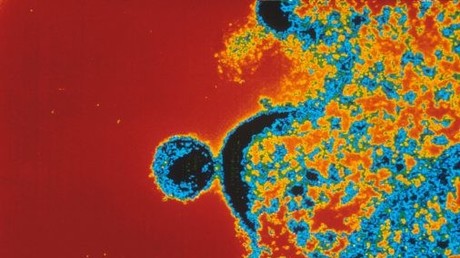 Erst zweiter Fall weltweit: HIV-Patient möglicherweise geheilt