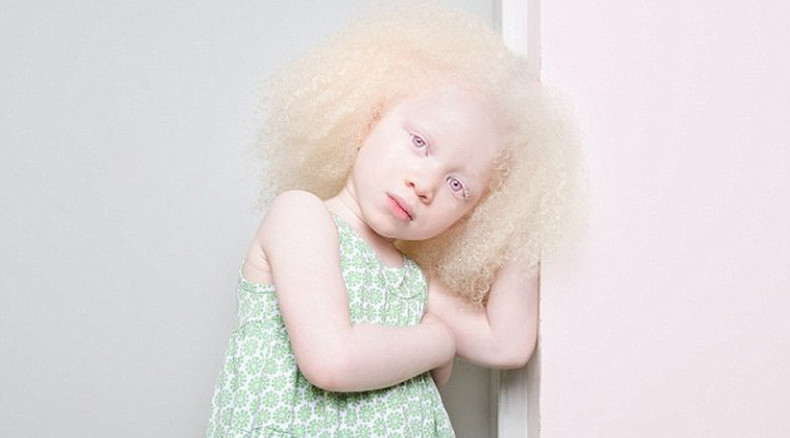 One In 000 Extraordinary Albino Beauty Revealed In Rare Photoshoot Amazing Photos Rt World News