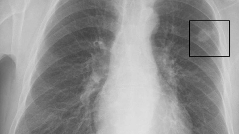 Cancer deaths drop 23%, but it is now top killer in much of US