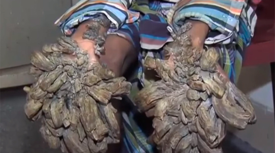 Treeman Receives Surgery For Huge Barklike Tumors VIDEO RT Viral