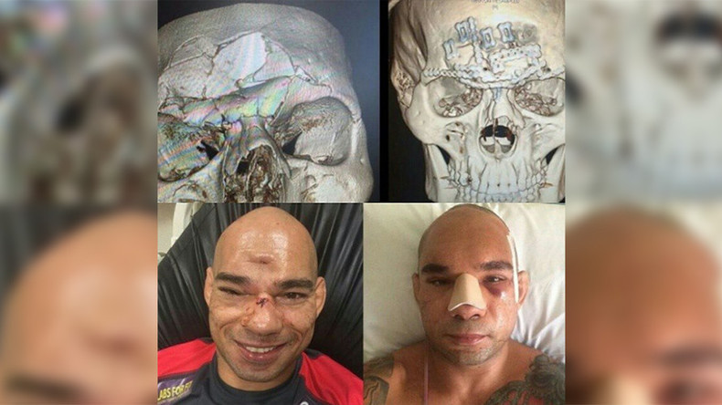 Cyborg" Santos successfully undergoes seven-hour surgery on horrific head injury (PHOTOS) — RT Sport News