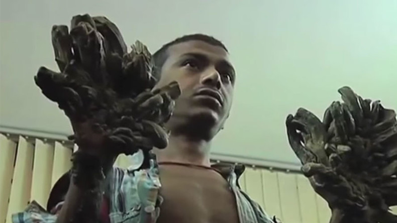 ‘Tree man’ of Bangladesh ‘cured’ after undergoing 16 surgeries (PHOTOS)
