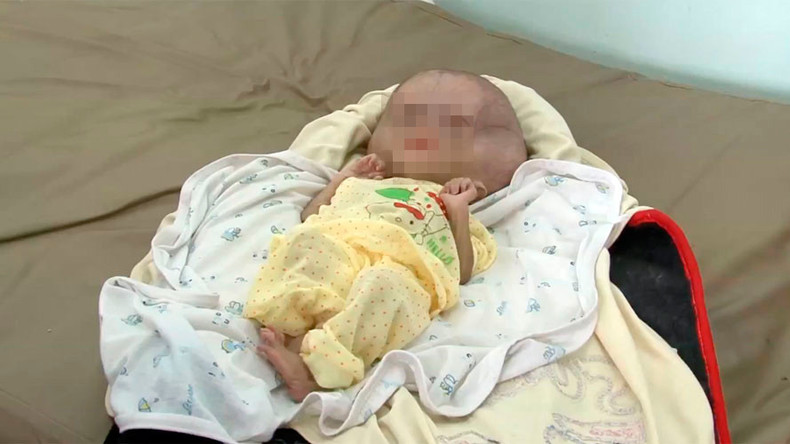 Infant deformities in Yemen linked to Saudi-led bombardment (GRAPHIC VIDEO)