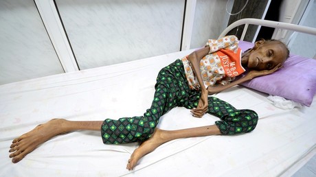 Saida Ahmed Baghili, 18, lies on a bed at the al-Thawra hospital where she receives treatment for severe malnutrition in the Red Sea port city of Hodeidah, Yemen © Reuters/ ABDULJABBAR ZEYAD