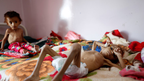 FILE PHOTO: Malnourished Yemeni children receive treatment © Reuters / Khaled Abdullah