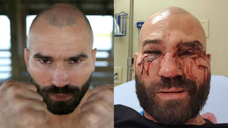 Former UFC fighter Artem Lobov before and after his bareknuckle boxing match © Reuters / JONATHAN BACHMAN |© Instagram / rushammer